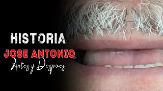 💚6 IMPLANTES dentales en maxilar superior y 👉PROTESIS FIJA👈 zirconio monolitico Antes y Despues [upl. by Antonio]