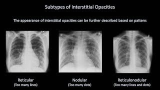 How to Interpret a Chest XRay Lesson 7  Diffuse Lung Processes [upl. by Bourne135]