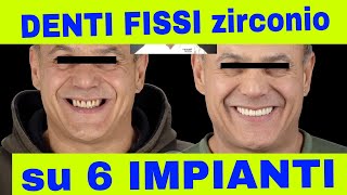 Denti fissi su 6 Impianti in ZIRCONIO [upl. by Hebrew]