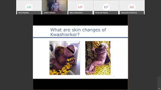 Overt signs of kwashiorkor Looking at edema and beyond [upl. by Fairbanks530]