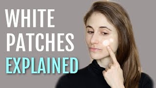 WHITE PATCHES ON THE FACE EXPLAINED PITYRIASIS ALBA DR DRAY [upl. by Chud]