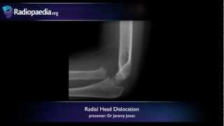 Radial head dislocation  radiology video tutorial xray [upl. by Vani]