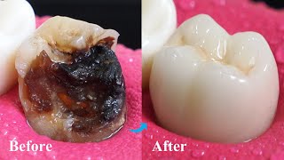 Incredible Restoration Of Tooth By Root Canal And Zirconia Crown [upl. by Gnol566]