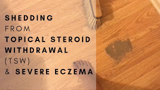 Healing Topical Steroid Withdrawal TSW amp Severe Eczema  The Nat Nurse [upl. by Rod382]