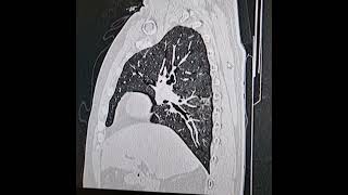 Desquamative interstitial pneumonia Coronal and sagittal images images [upl. by Kirby761]