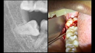Extracción MUELA DEL JUICIO horizontal  Extracción de cordal incluido [upl. by Forcier229]