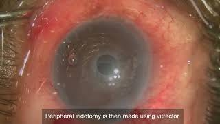 Descemet Membrane Endothelial Keratoplasty DMEK [upl. by Craw]