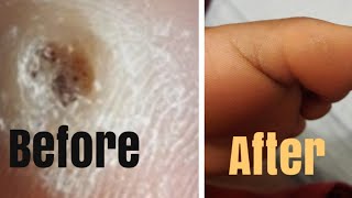 Plantar Wart treatment  Update Part 2 [upl. by Godding]