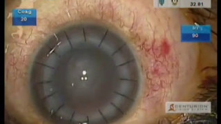 Keratoplasty DALK with WaveLight® FS200 Femtosecond Laser [upl. by Haelat]