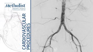 External Iliac Artery Balloon Angioplasty and Stenting Alan B Lumsden MD M Mujeeb Zubair MD [upl. by Nillok]