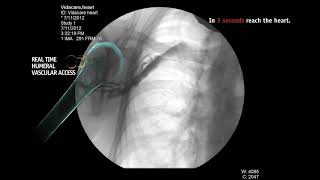 Intraosseous Infusion From Right Humeral Head [upl. by Anuahc]