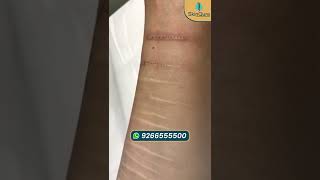 Non surgical scar improvement only at SkinQure Delhi  Laser Scar Removal [upl. by Guthry]