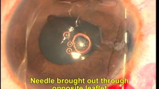 Siepser knot iridoplasty in phakic eye Soosan Jacob 22 min [upl. by Emeline]