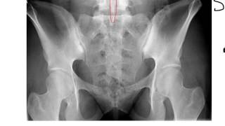 Sacrum Coccyx and SI Joints [upl. by Tiloine993]