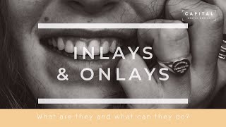 Dental Inlays amp Onlays Explained by Richmond Cosmetic Dentist Dr Graham Forbes [upl. by Anawat]