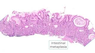 Autoimmune gastritis and differential diagnosis [upl. by Ovatsug]