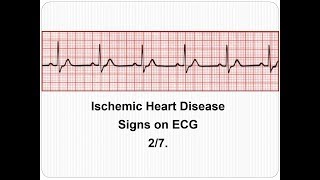 ECG Ischemic Heart Disease 27 ECG manifestations [upl. by Nossila148]