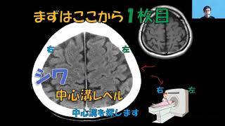 SCU看護（急性期の脳卒中ケア）amp脳画像の見方（Ver2）サンプル動画 [upl. by Wyne690]