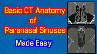 Basic CT Anatomy of Paranasal Sinuses Made Easy [upl. by Schug]