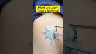 PicoSure Laser Tattoo Removal Pico Laser Before and After Picosecond Laser Pico Laser machine [upl. by Nonrev]