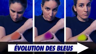 Pourquoi les ecchymoses changent de couleur  Feat Primum Non Nocere [upl. by Anai]