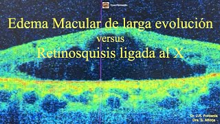 Edema Macular de larga evolución vs Retinosquisis ligada al X [upl. by Alper43]