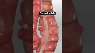 Diverticulitis 3D Animation [upl. by Farrica]