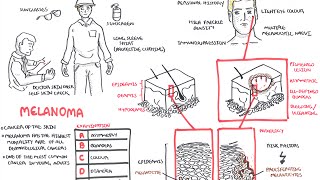 Melanoma  Overview signs and symptoms pathology risk factors treatment [upl. by Nauaj543]