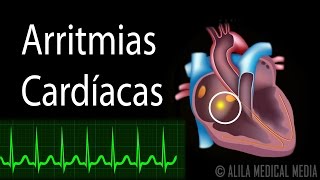 Arritmias Cardíacas Animación Alila Medical Media Español [upl. by Assilrac71]