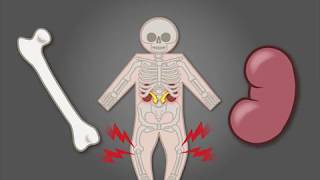 Treating XLinked Hypophosphatemia in Children [upl. by Tterab593]