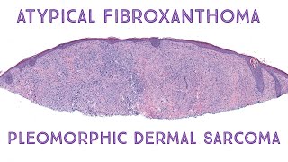 Atypical Fibroxanthoma amp Pleomorphic Dermal Sarcoma Oregon case 2 [upl. by Odab]