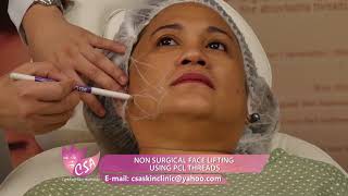 NON SURGICAL FACE LIFT USING PCL THREADS [upl. by Mandie]