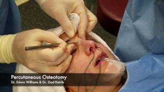 Percutaneous Osteotomy amp Breaking the Nose During Rhinoplasty Surgery [upl. by Naima]