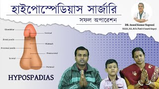 Hypospadias  প্রস্রাব সঠিক জায়গায় না খোলার সমস্যা  Hypospadias Repair in India  Dr Nagwani [upl. by Aneekahs571]