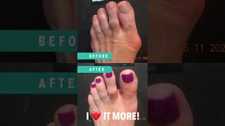 CRAZY BUNION BEFORE AND AFTER 😱 bunion buniontreatment [upl. by Chong842]