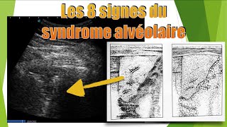 8 aspects de pneumopathie en échographie [upl. by Dumah]