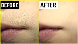 पाएं अनचाहे बालों से छुटकारा  Permanent Hair Removal  Anaysa [upl. by Carilyn]