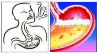 Damage from Helicobacter pylori [upl. by Erej]