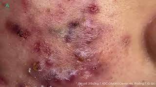 Big Cystic Acne Blackheads Extraction Blackheads amp Milia Whiteheads Removal Pimple Popping [upl. by Assirat]