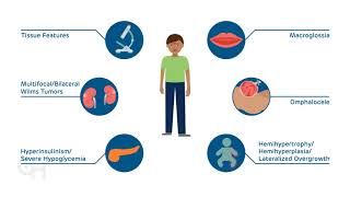 Introduction to BeckwithWiedemann Syndrome BWS [upl. by Airec]