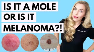 Is It A Mole or Melanoma This Might Save Your Life  Dermatologist Tips [upl. by God]