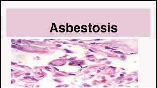 Asbestosis [upl. by Nnahgiel]