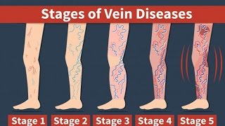 Natural Home Remedies For Varicose Veins Treatment at Home [upl. by Dragelin]