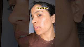 Tretinoin cream before and after  January to December Transformation  tretinoin acne face  🤫 [upl. by Tnerual]