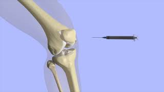 Knee Joint Injection [upl. by Forbes]