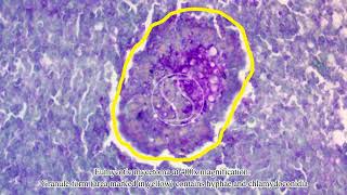 Eumycotic mycetoma under the microscope with McManus’ PAS stain [upl. by Otrebile]