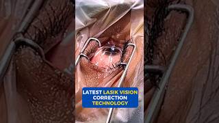 Latest Lasik Vision Correction Technology [upl. by Nohtiek730]