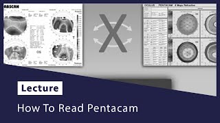 How To Read Pentacam [upl. by Nawoj776]