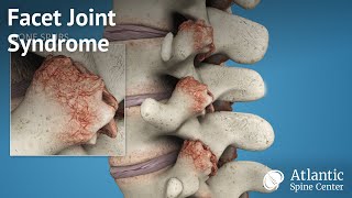 Facet Joint Syndrome [upl. by Kevyn]