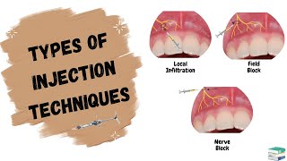 Types of Injections used in Dentistry  Local Anesthesia [upl. by Alaekim982]